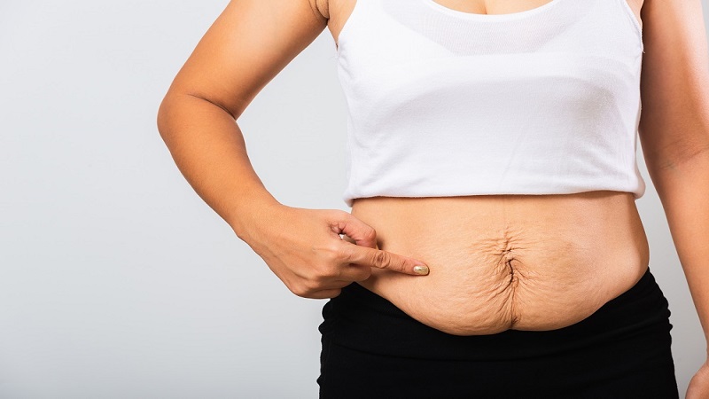 عمل کشیدن پوست شکم بعد از بارداری