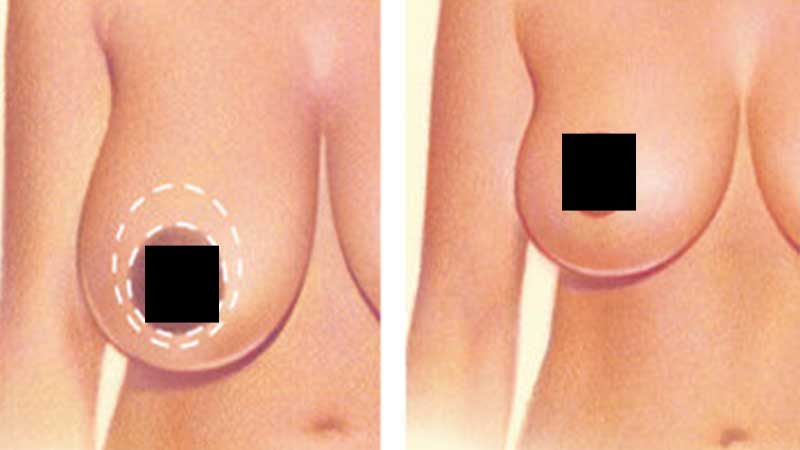 تصاویر قبل و بعد از ماموپلاستی