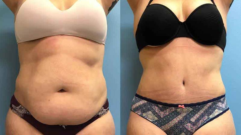 تصاویر قبل و بعد از عمل لیپوماتیک شکم و پهو