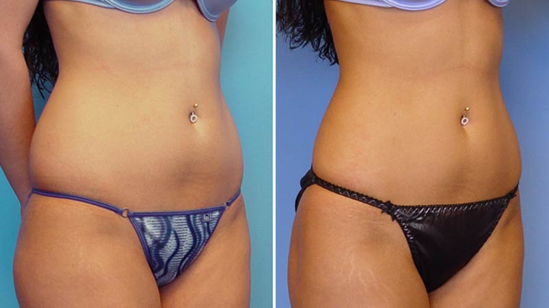 تصاویر قبل و بعد از لیپوماتیک شکم و پهلو