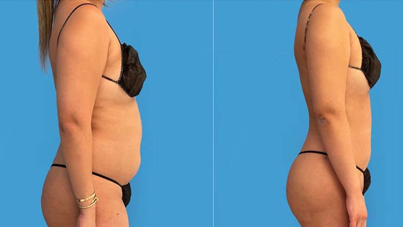 تصاویر قبل و بعد از عمل لیپوماتیک شکم و پهلو