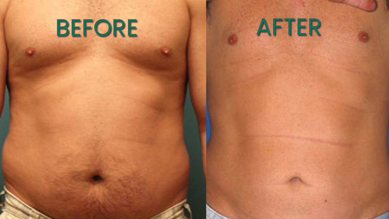 عکس های قبل و بعد از عمل لیپوماتیک شکم و پهو
