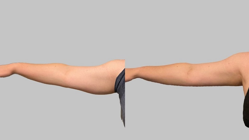 عوارض جانبی لیپوماتیک بازو 
