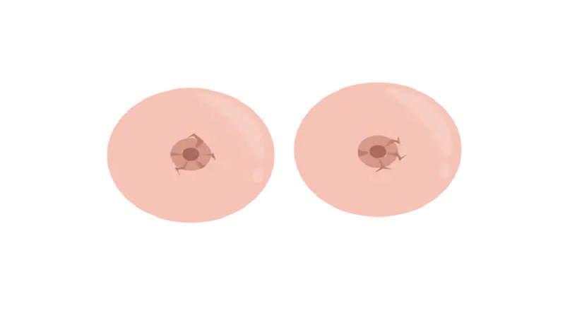 تصاویر عمل کوچک کردن هاله سینه