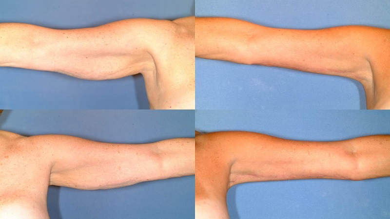 مضرات عوارض لیپوماتیک بازو 