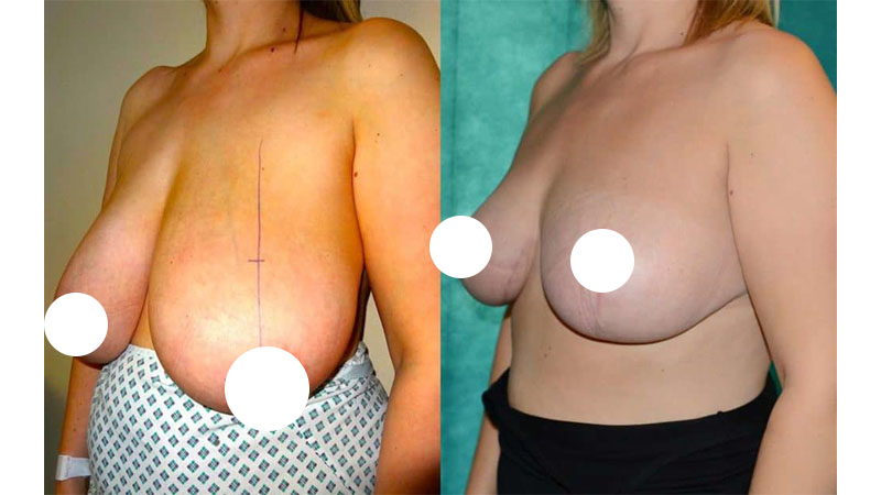 جراحی افتادگی سینه زنان 