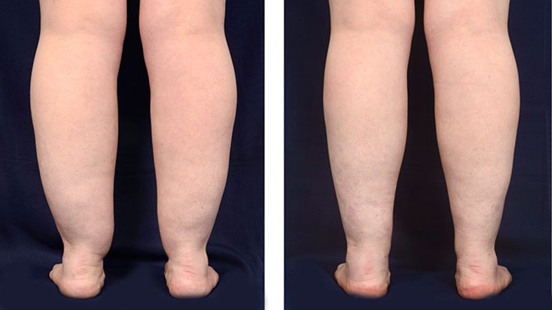 مراقبت های بعد از لیپوساکشن ساق پا 