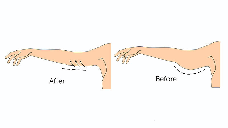 عوارض لیپوماتیک بازو