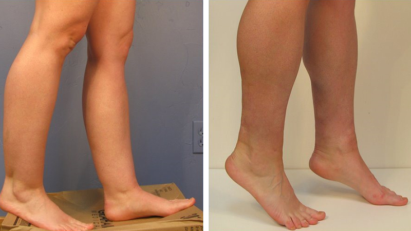 خطرات لیپوساکشن ساق پا 