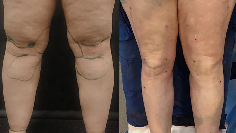 نتایج لیپوساکشن ساق پا 