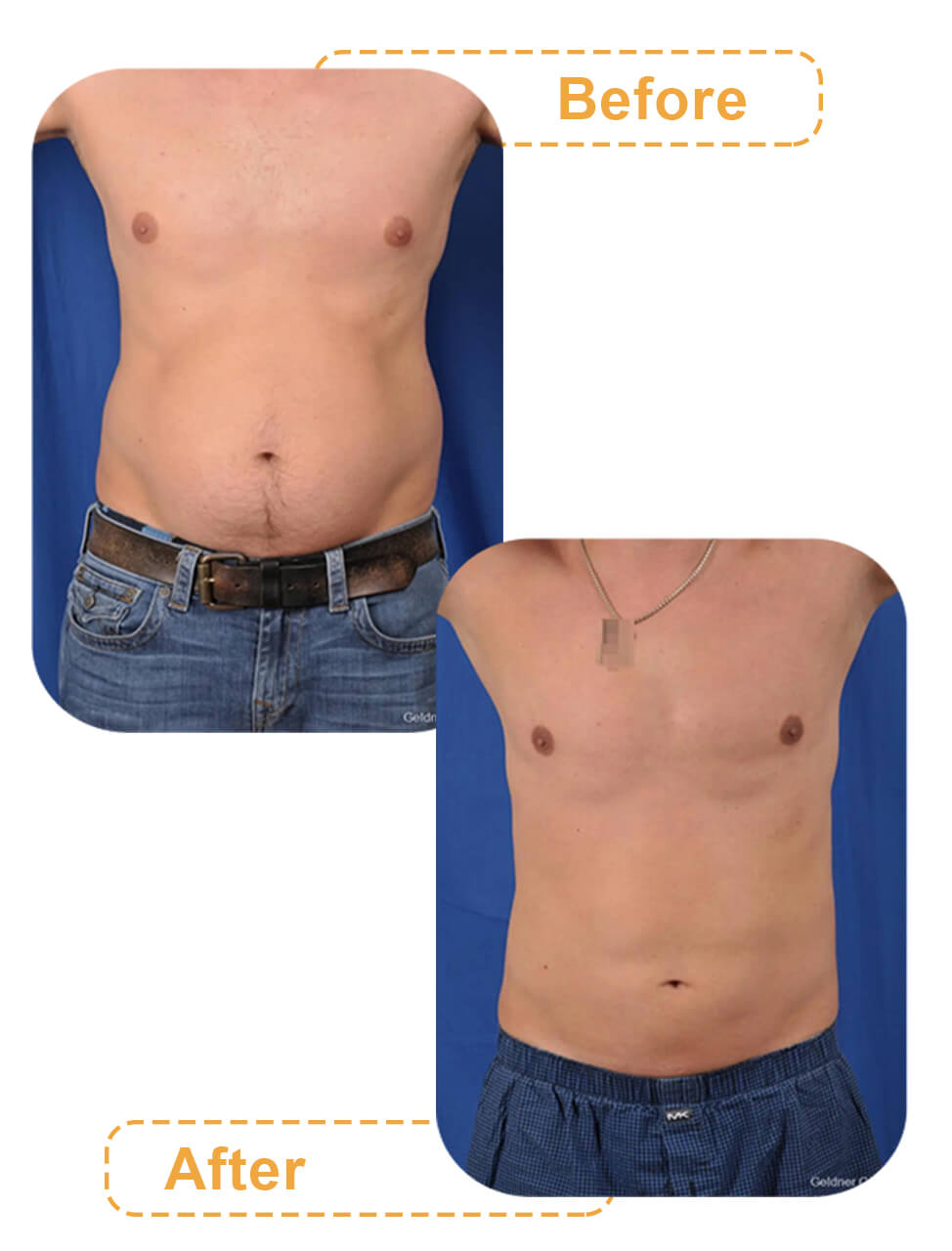 قبل و بعد جراحی لاغری شکم و پهلو