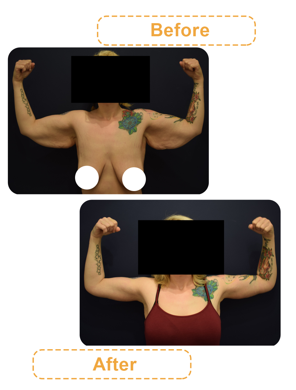 عکس های قبل و بعد لیپوساکشن بازو