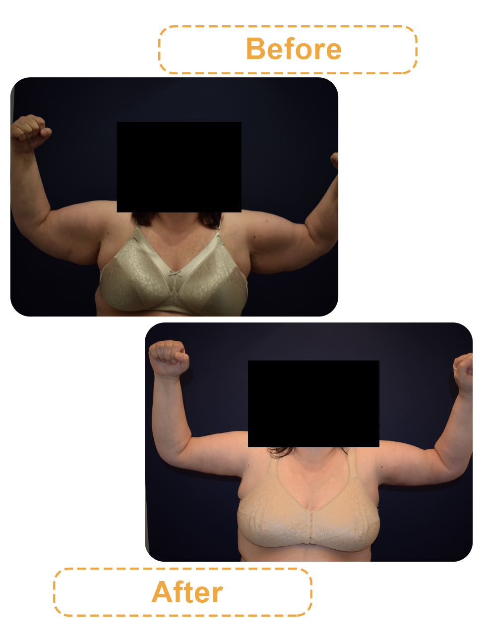 عکس قبل و بعد لیپوساکشن بازو