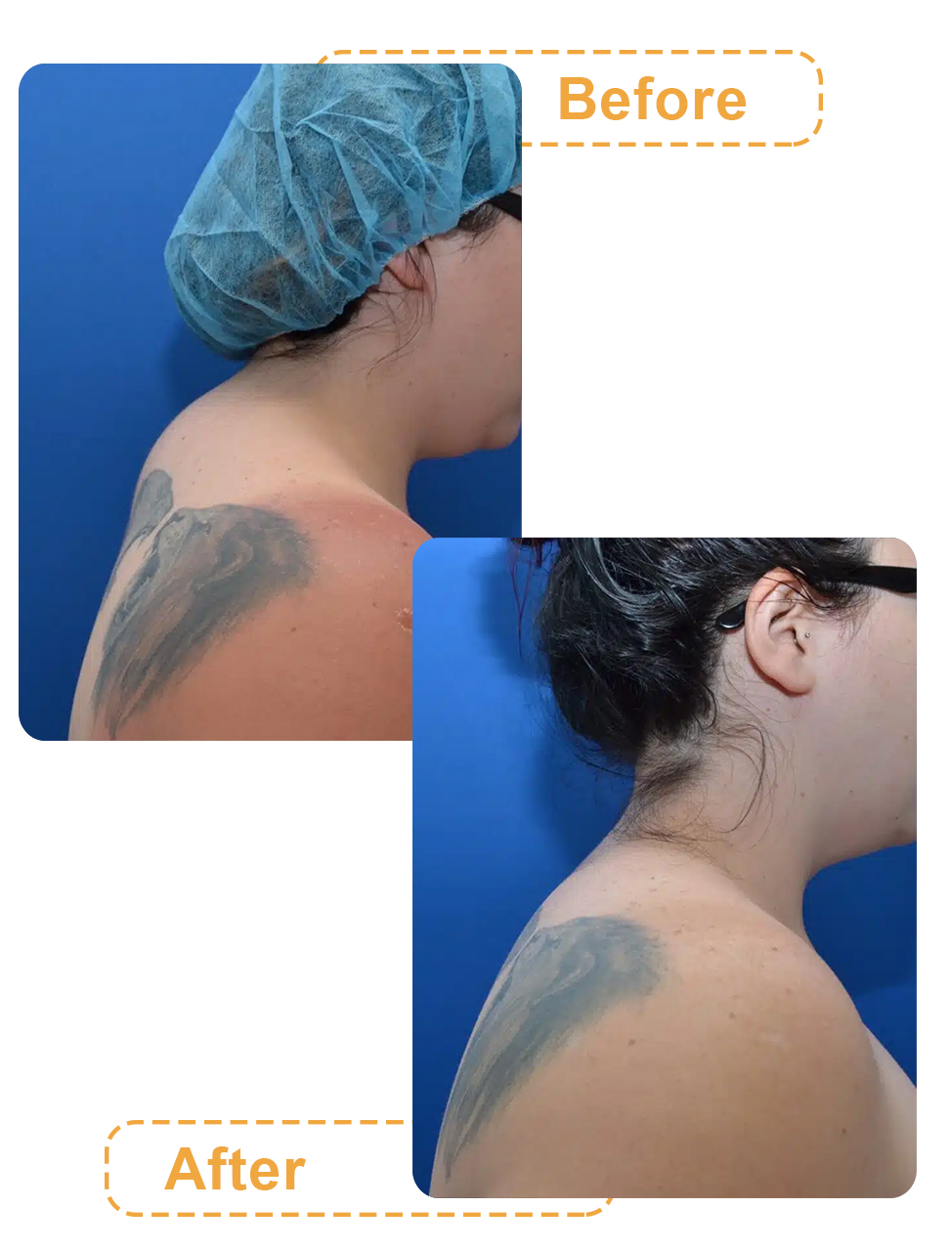 تصاویر قبل و بعد لیپوساکشن پشت گردن