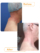 عکس قبل و بعد لیپوماتیک پشت گردن