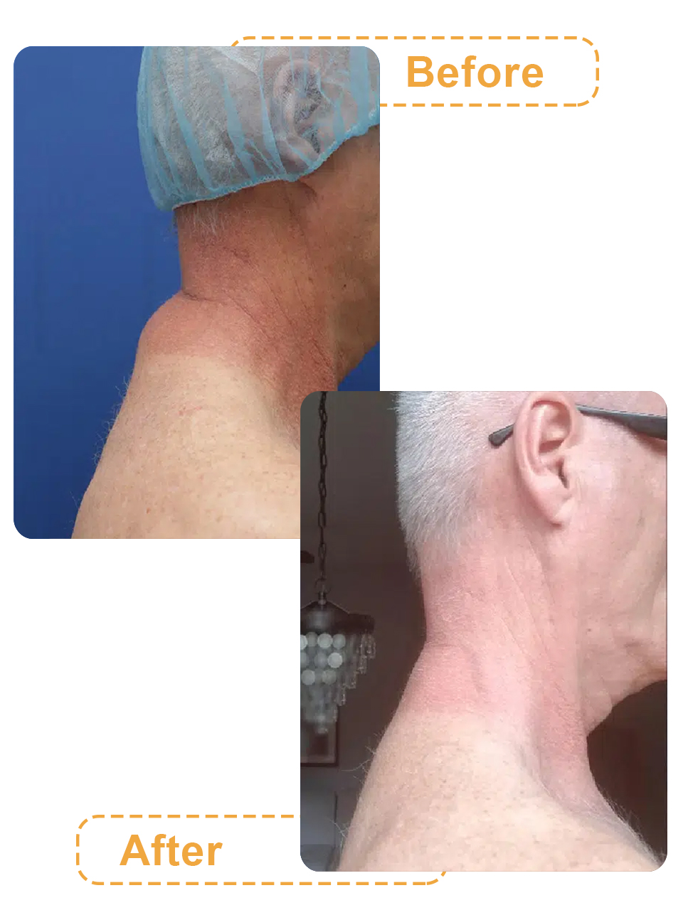 عکس قبل و بعد لیپوماتیک پشت گردن