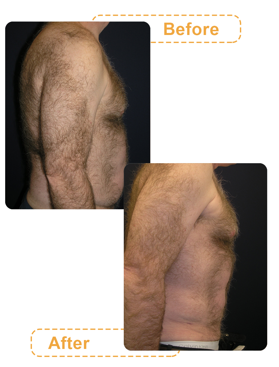 عکس قبل و بعد لیپوساکشن شکم آقایان