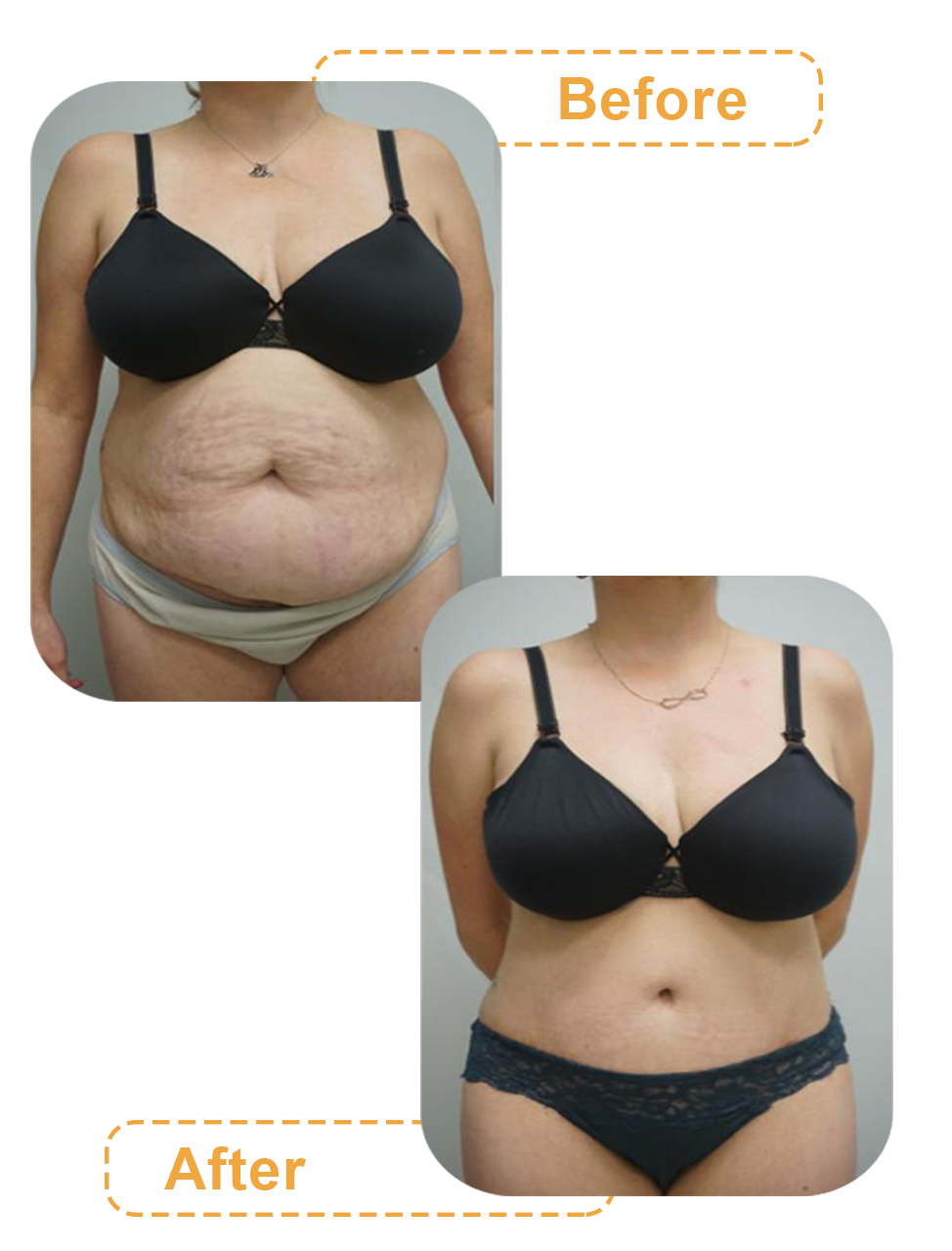 تصاویر قبل و بعد جراحی لاغری شکم
