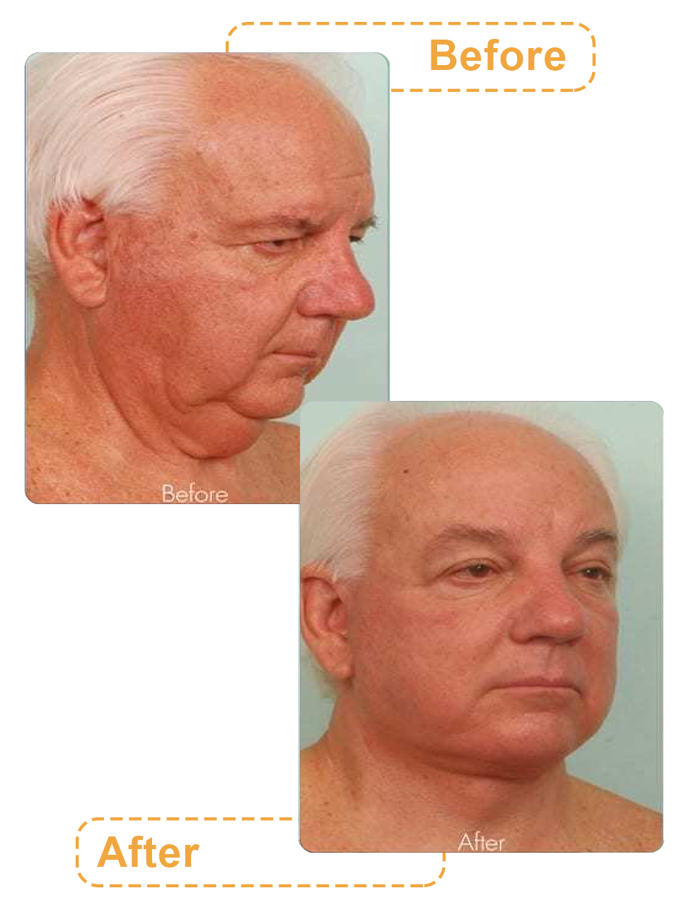 عکس قبل و بعد جراحی زیبایی صورت آقایان