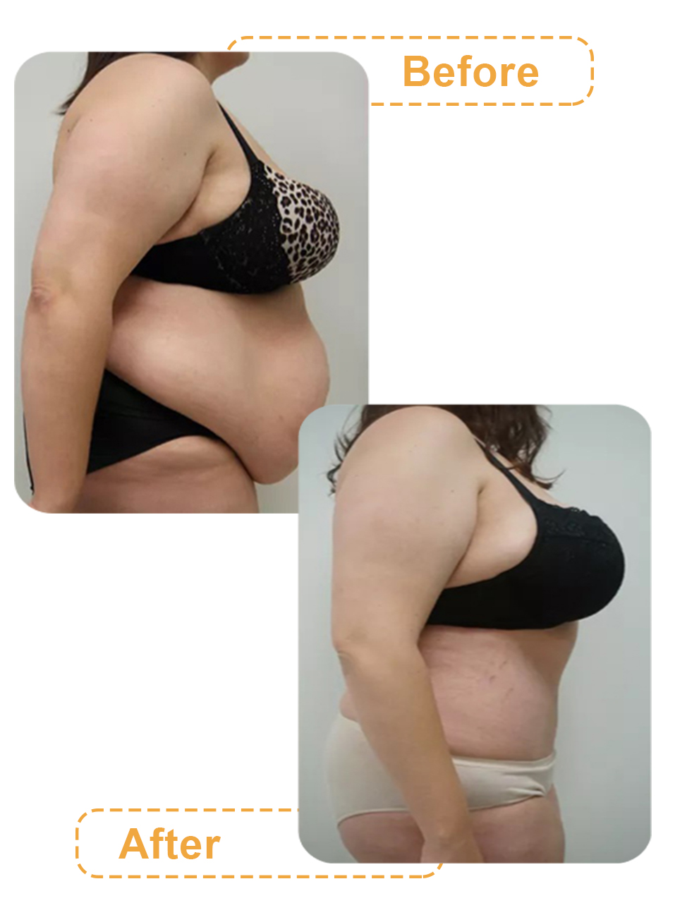 عکس های قبل و بعد عمل کوچک کردن شکم