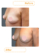 تصاویر قبل و بعد بزرگ کردن سینه با عمل