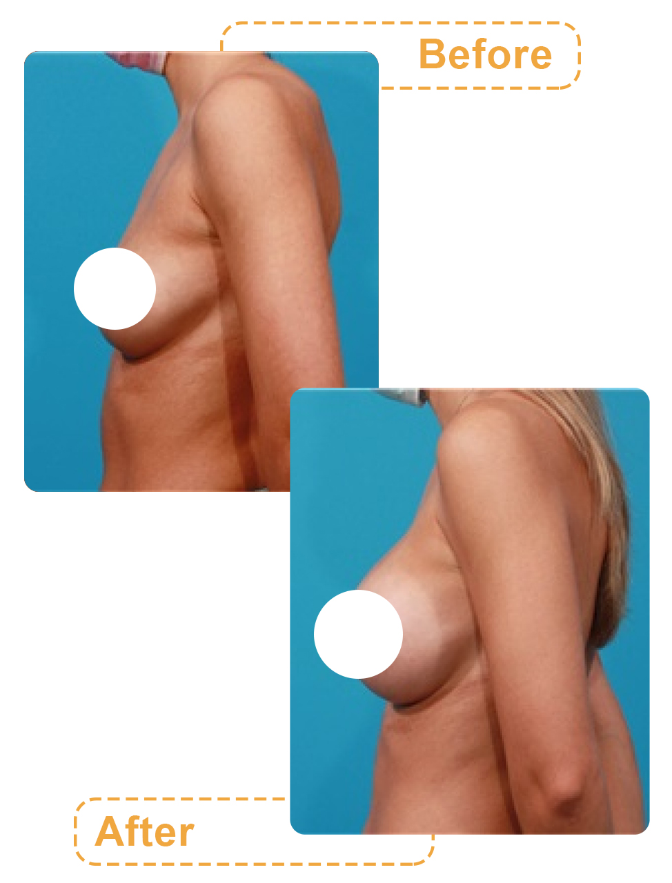 تصویر قبل و بعد بزرگ کردن سینه با عمل