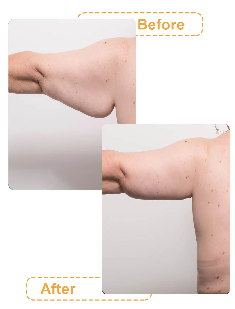 عکس های قبل و بعد لیپوماتیک بازو
