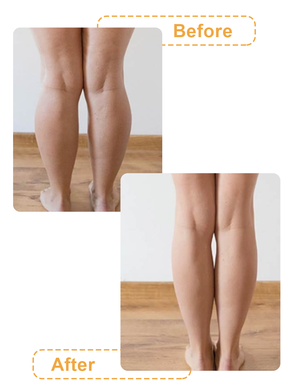 تصاویر لیپوماتیک ساق پا