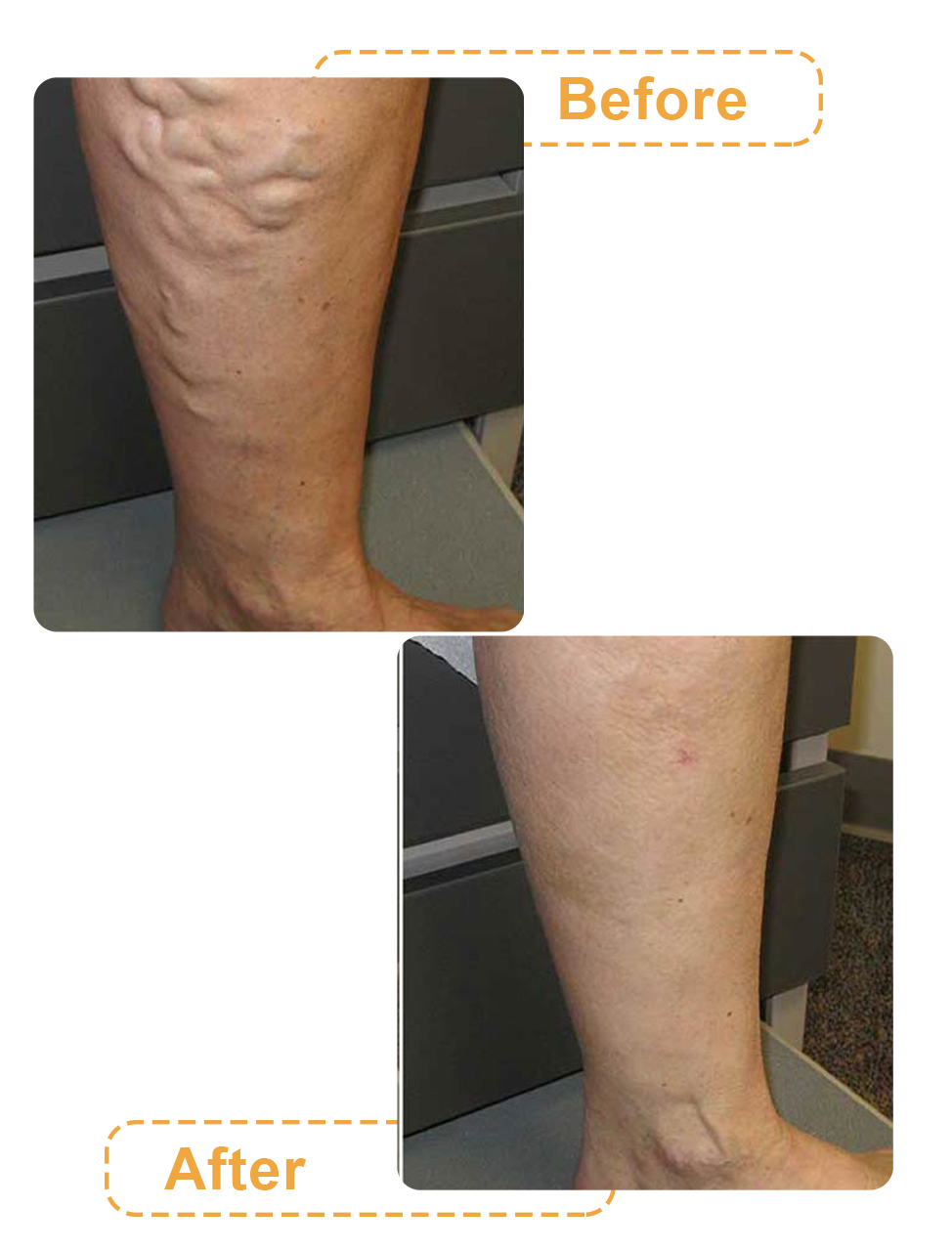 عکس های قبل و بعد لیپوماتیک ساق پا