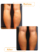 عکس قبل و بعد لیپوماتیک ساق پا