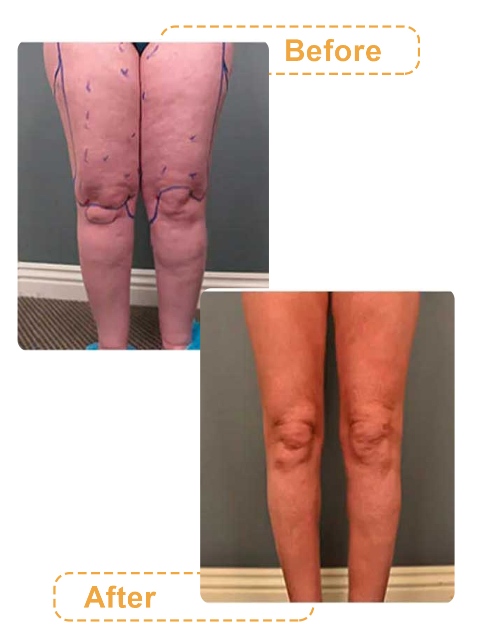 تصاویر جراحی لیپوماتیک ساق پا