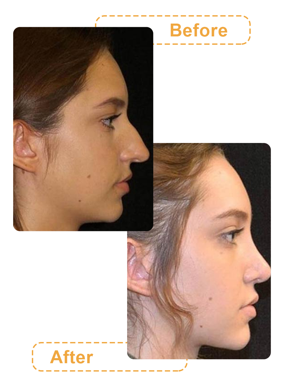 تصاویر قبل و بعد از جراحی بینی