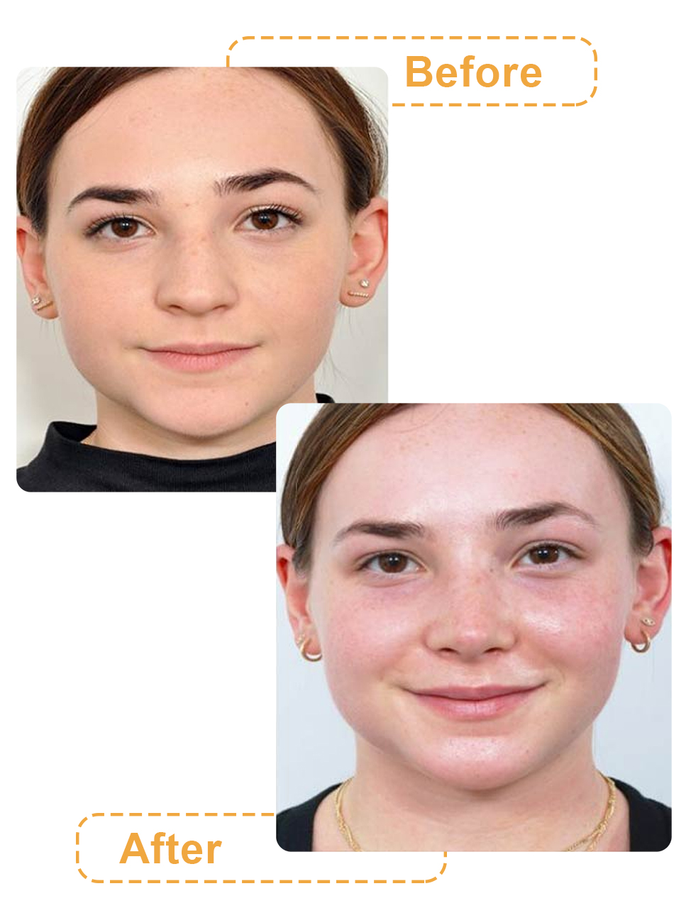 عکس های قبل و بعد جراحی بینی گوشتی