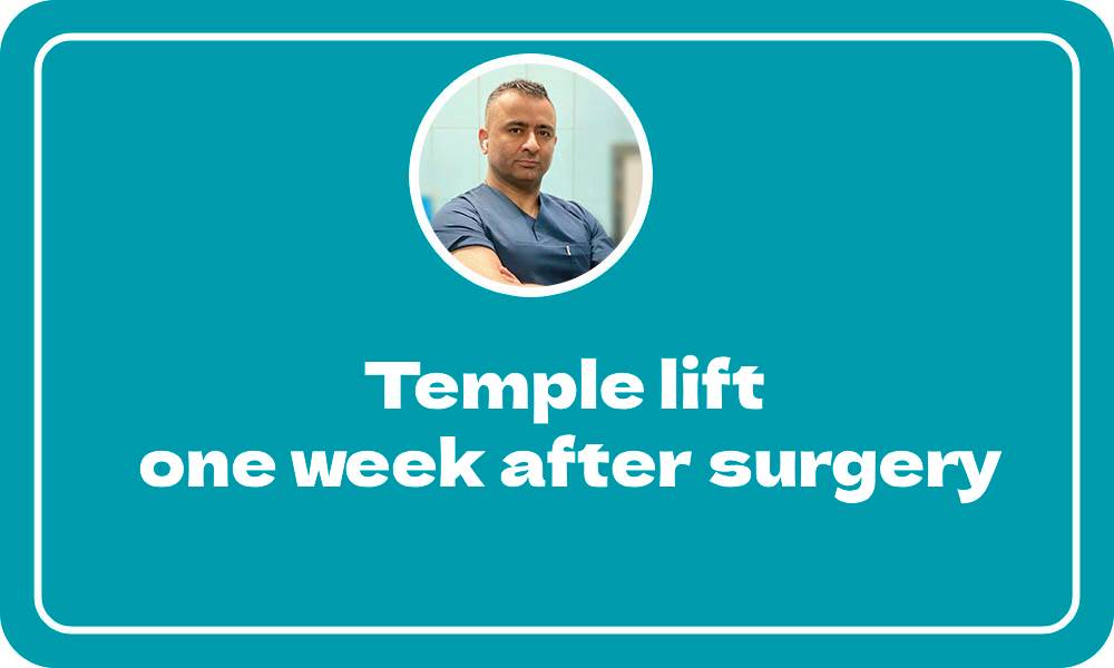 Temple lift, one week after surgery