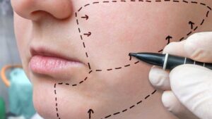 facelift in tehran
