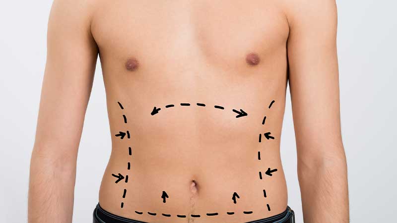 abdominoplasty