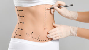 abdominoplasty