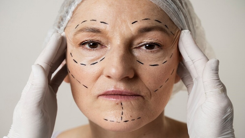 image of facelift