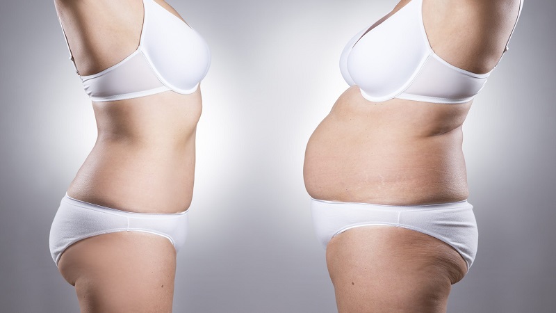 Benefits of Abdominoplasty