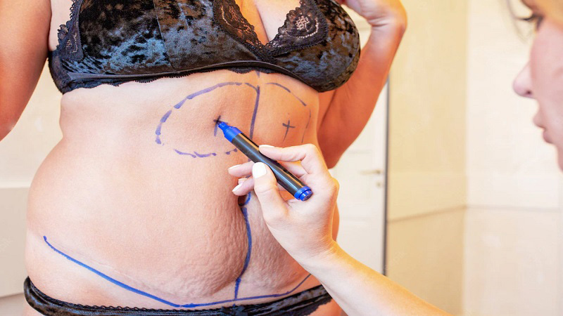 image of abdominoplasty