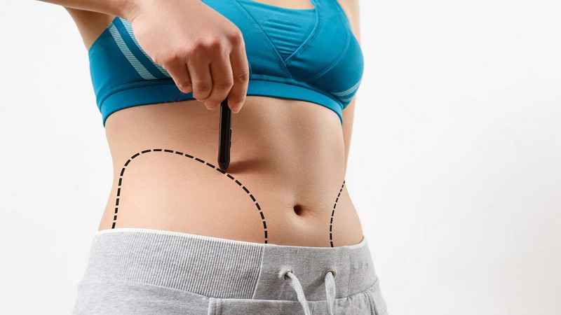abdominoplasty surgery